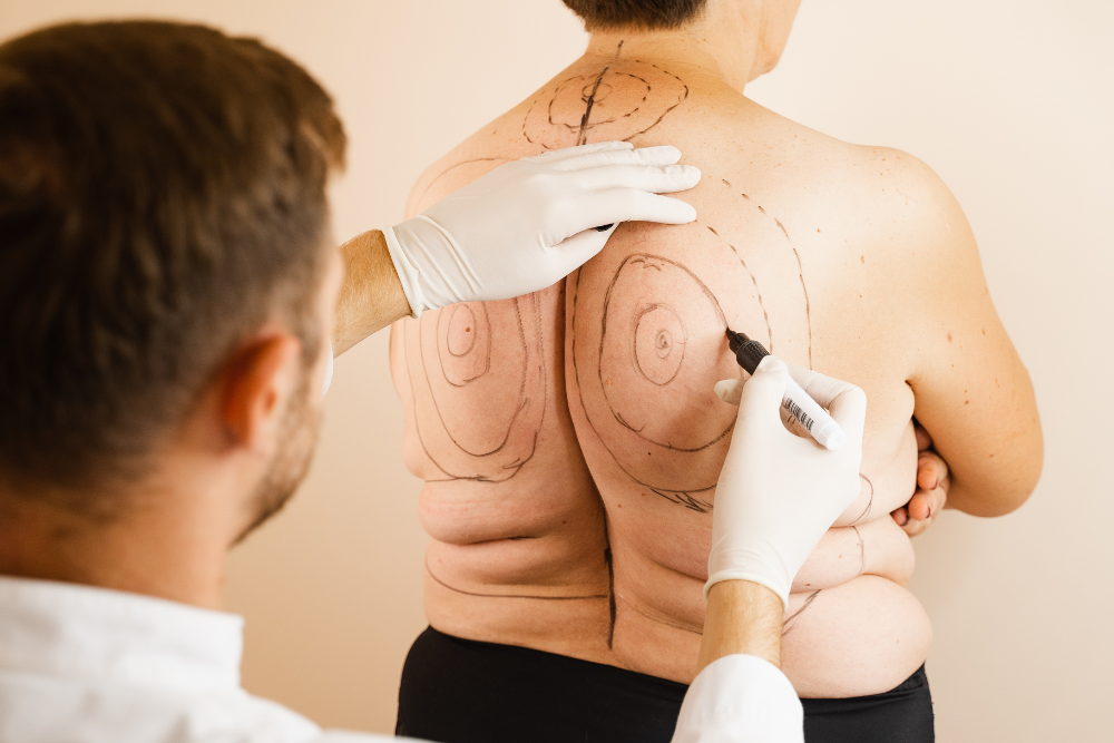 Key Qualities of Top-Rated Liposuction Clinics in DeBary, Florida