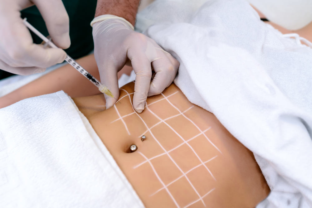 Liposuction for Belly Fat in Altamonte Springs, FL