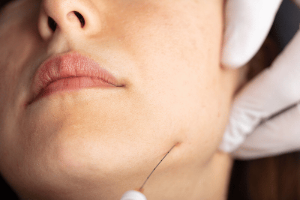 Dermal Filler Cost and Facial Balancing Near Sanford FL