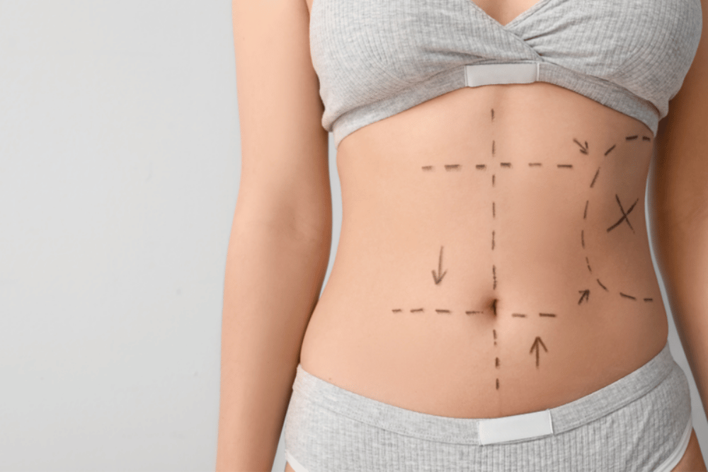 Best Liposuction Surgeon Longwood FL