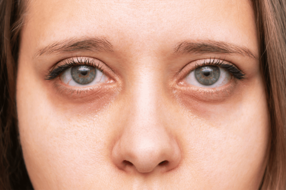 Under Eye Filler Sanford FL