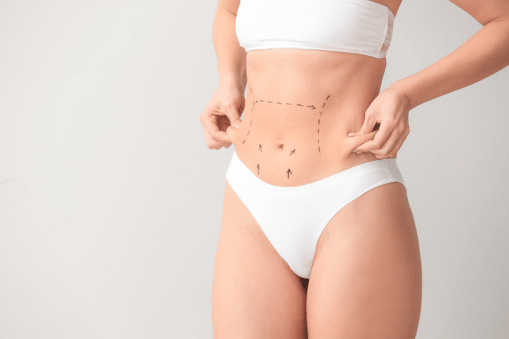 Liposuction Cost Lake Mary FL