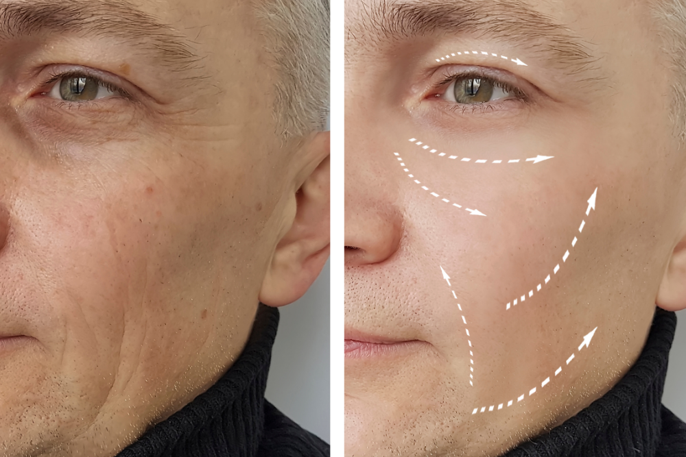 Best Dermal Fillers Near DeBary FL